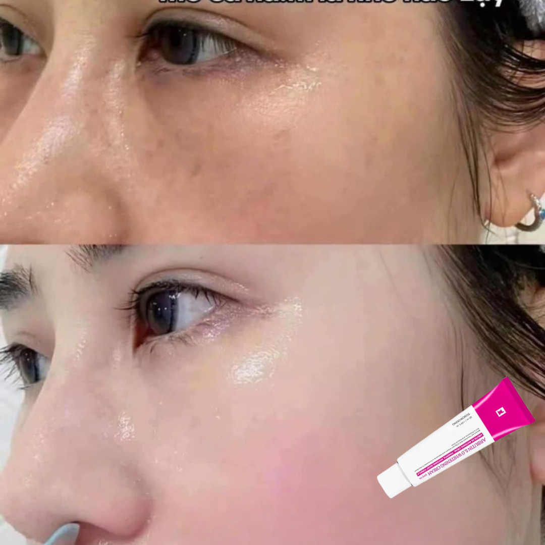 Arbutin Intensive Spot Cream (Remove acne spots & pigmentation + Gives Clear & Bright Skin)