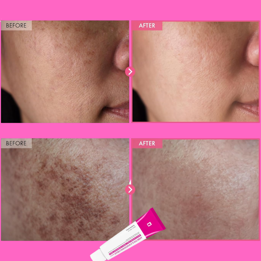 Arbutin Intensive Spot Cream (Remove acne spots & pigmentation + Gives Clear & Bright Skin)