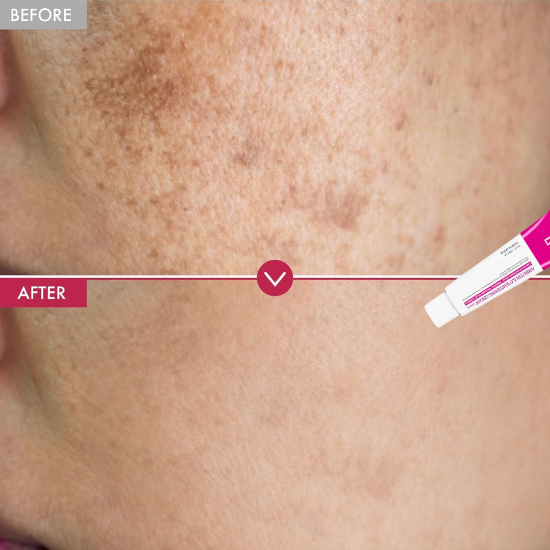 Arbutin Intensive Spot Cream (Remove acne spots & pigmentation + Gives Clear & Bright Skin)