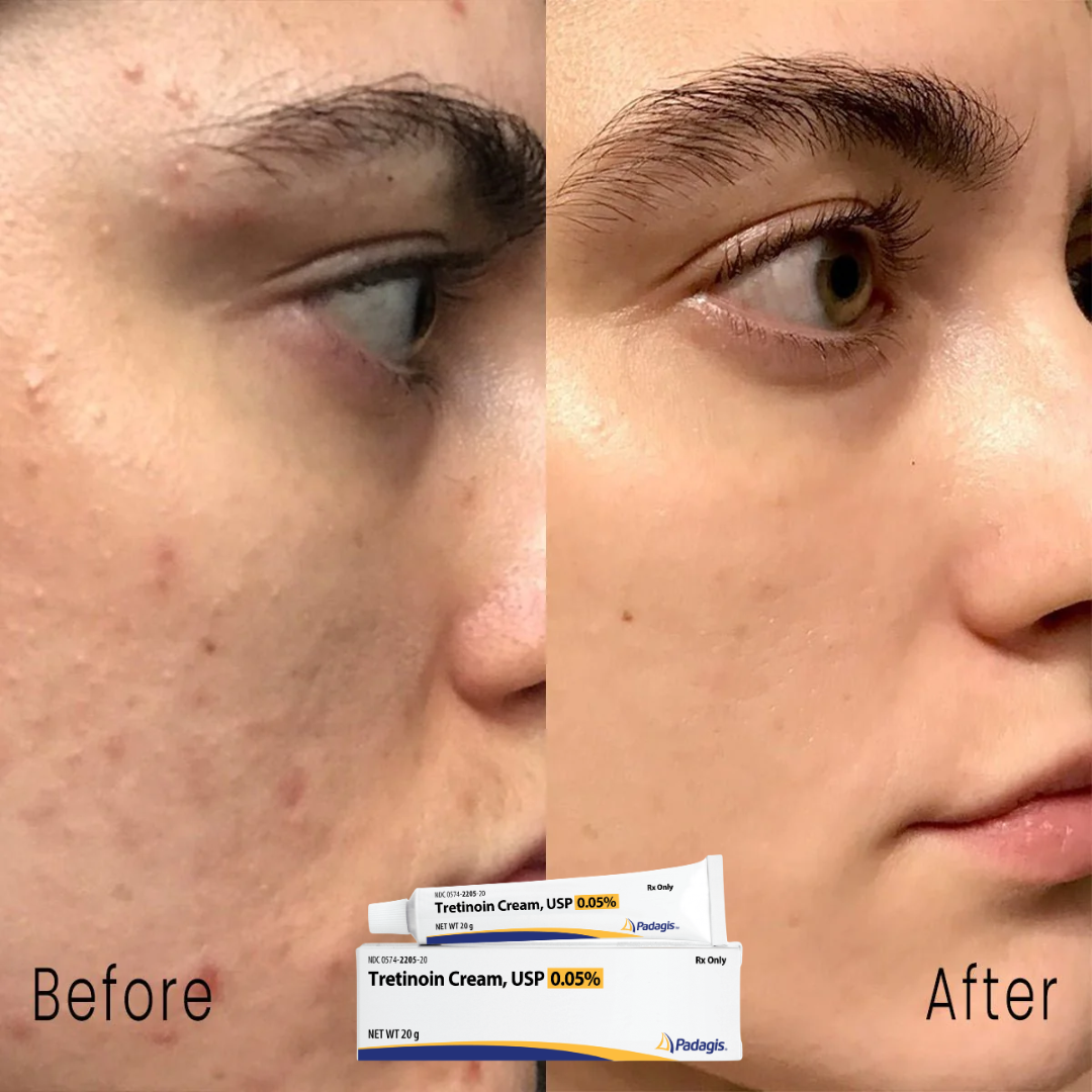 Tretinoin Cream USP