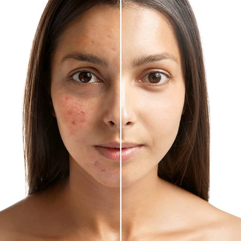 Chemist at play Vitamin C serum - Reduce Ance & dark spots and Brighten skin tone in just 7 days