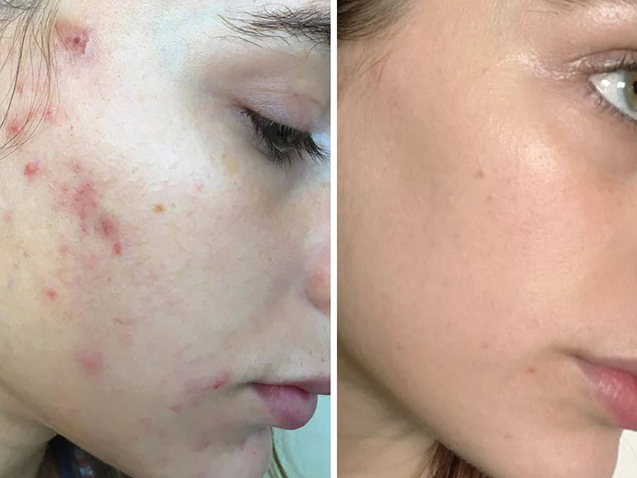 Chemist at play Vitamin C serum - Reduce Ance & dark spots and Brighten skin tone in just 7 days